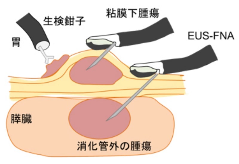 EUS-FNA